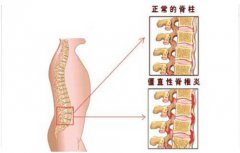 如何预防强直性脊柱炎?