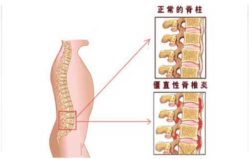 如何预防强直性脊柱炎?