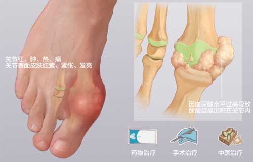 痛风的治疗方法有哪些?