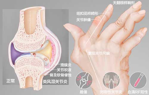 类风湿关节炎早期症状表现有哪些?如何治疗?